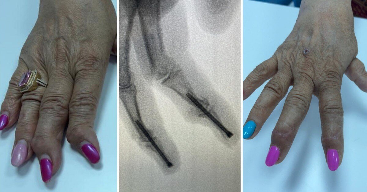 Artrită/Poliartrită reumatoidă, tratament, Dr. Vîlcioiu Înlocuirea totală a articulației